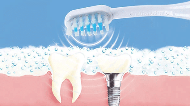 Обзор зубной щетки Emmi-dent 6 Professional "Go"